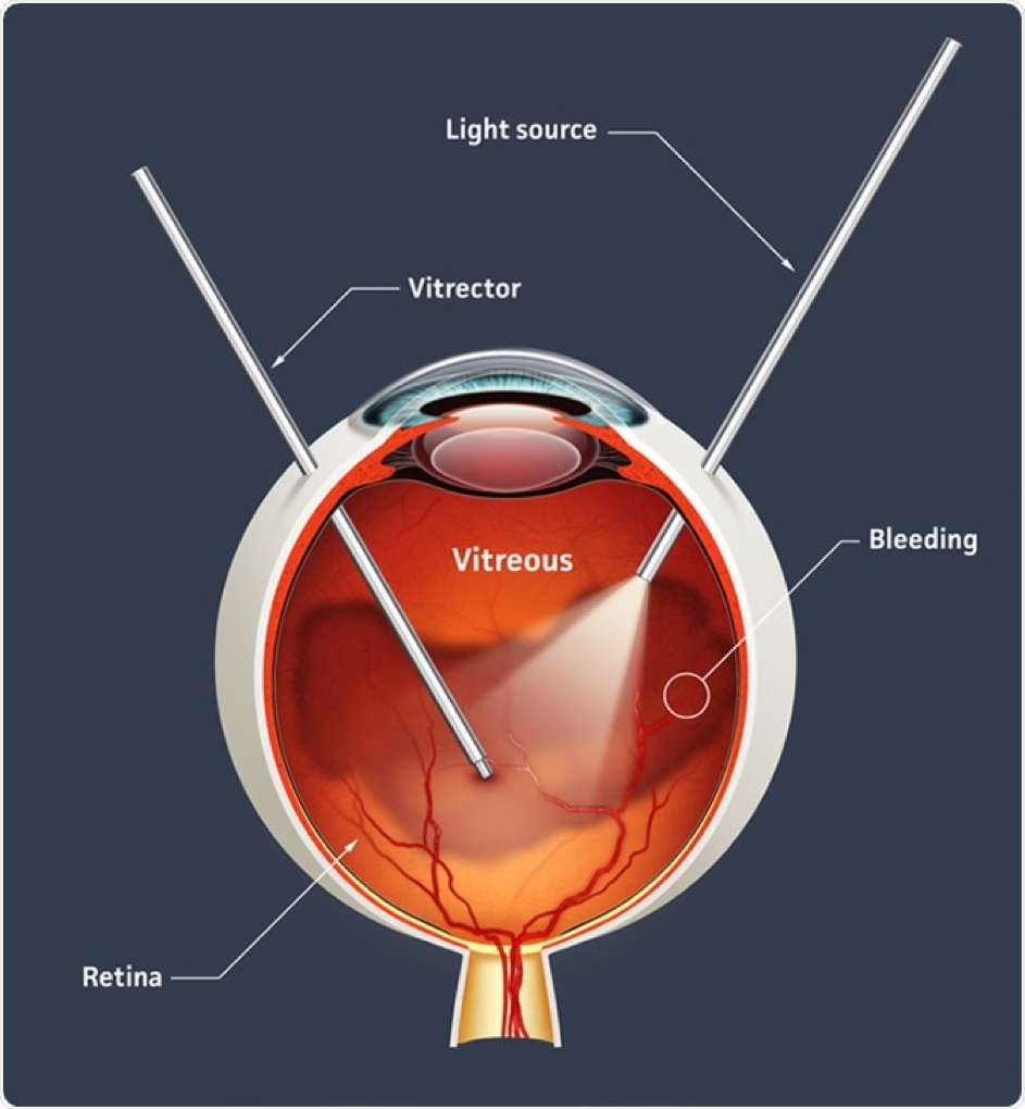 VİTREORETİNAL CERRAHİ (VİTREKTOMİ AMELİYATI)
